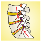 деформация дисков